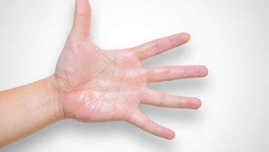 استفاده از جوش شیرین برای درمان عرق کف دست